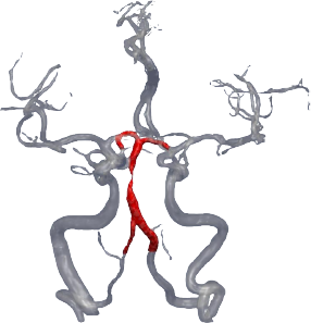 Stenosis